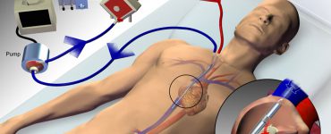 ecmo 1